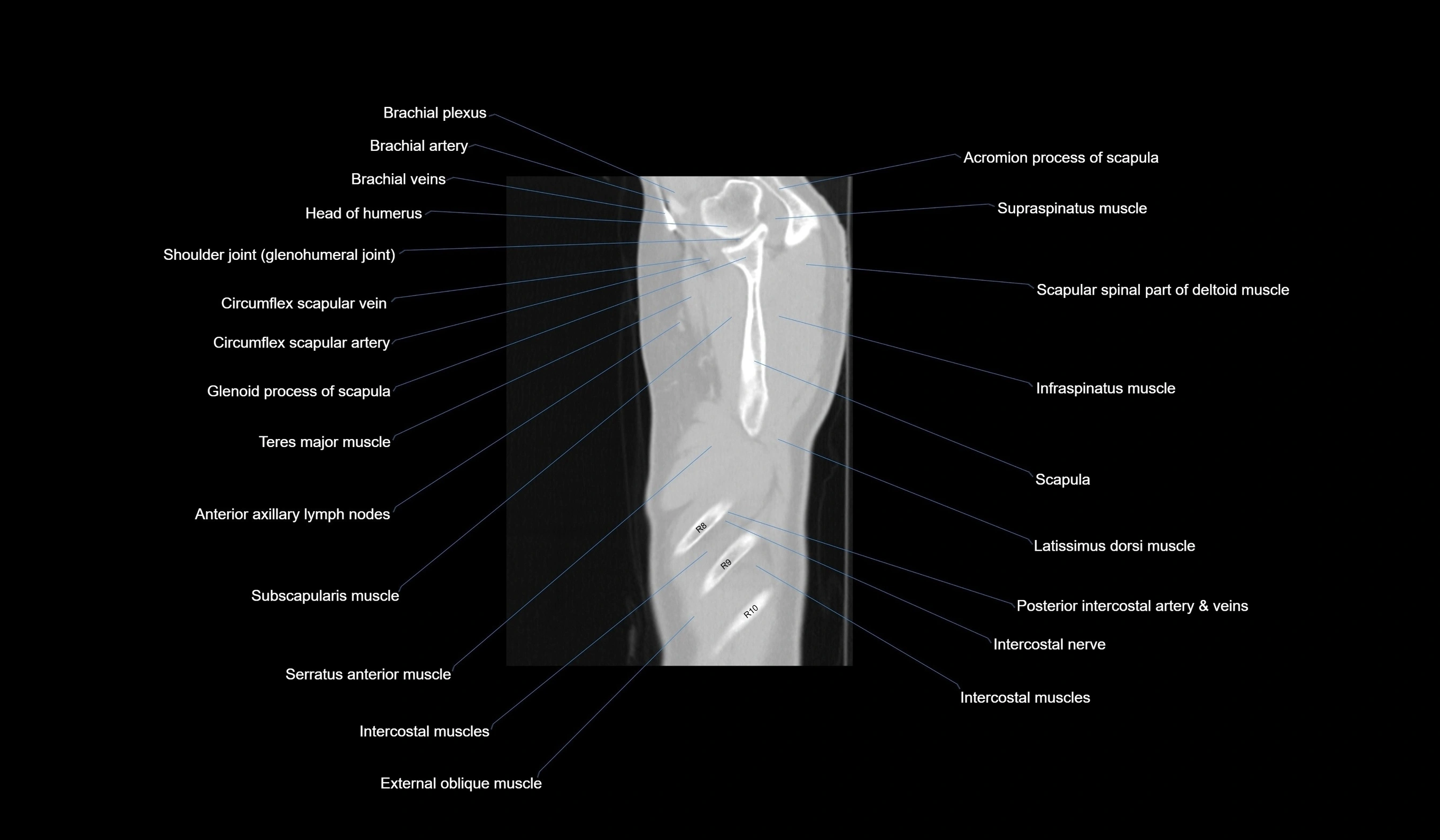 CT chest (thorax) lung window labelled sagittal cross sectional anatomy radiology image-00012.webp